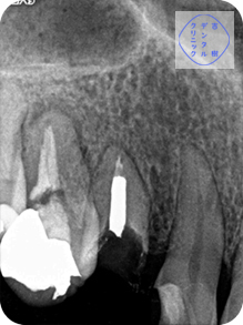 歯根破折症例