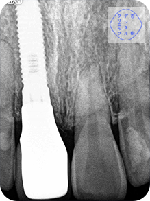 歯根破折症例