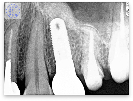 歯冠長延長手術